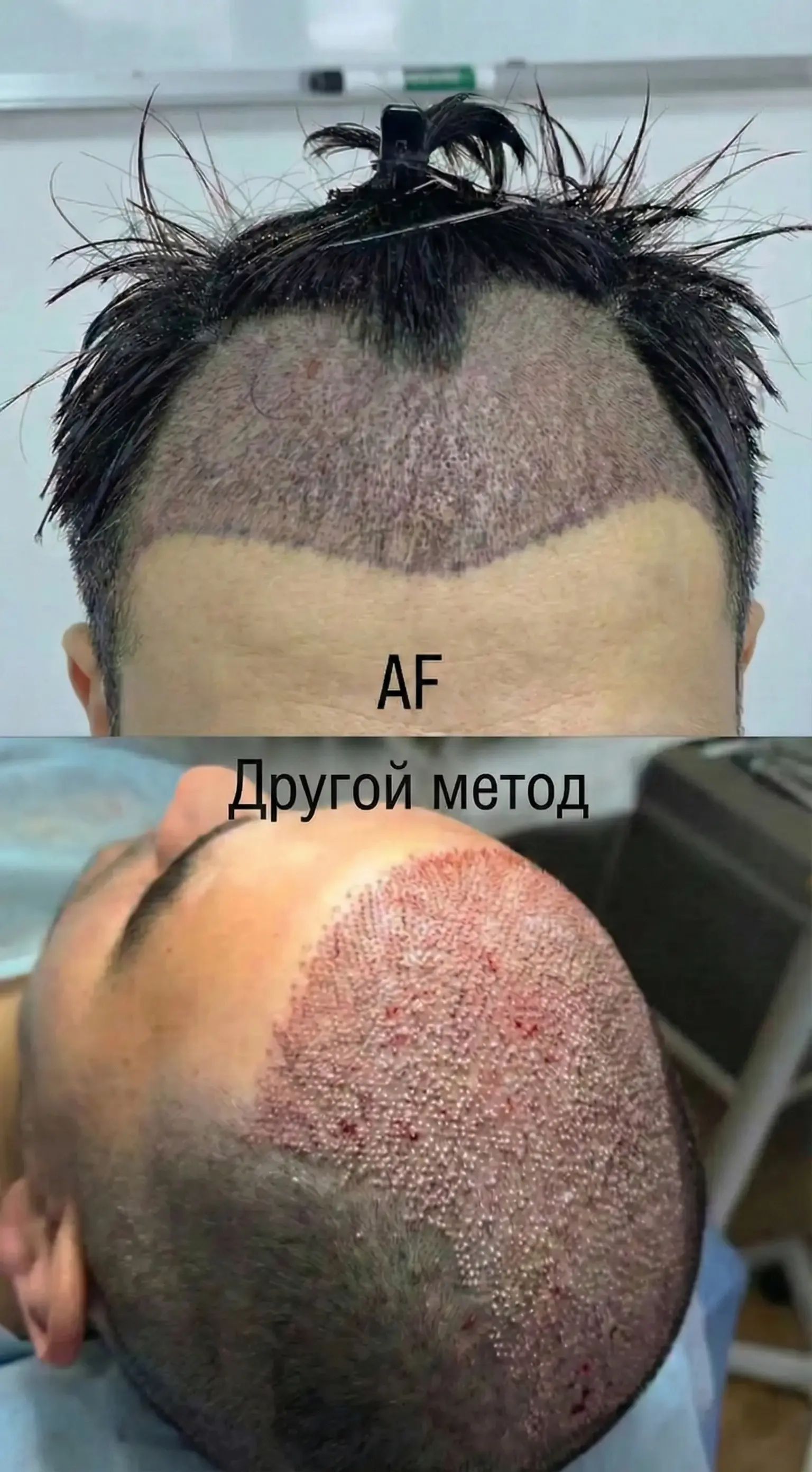 AF vs FUE hair transplant comparison - Follicle survival and healing time comparison