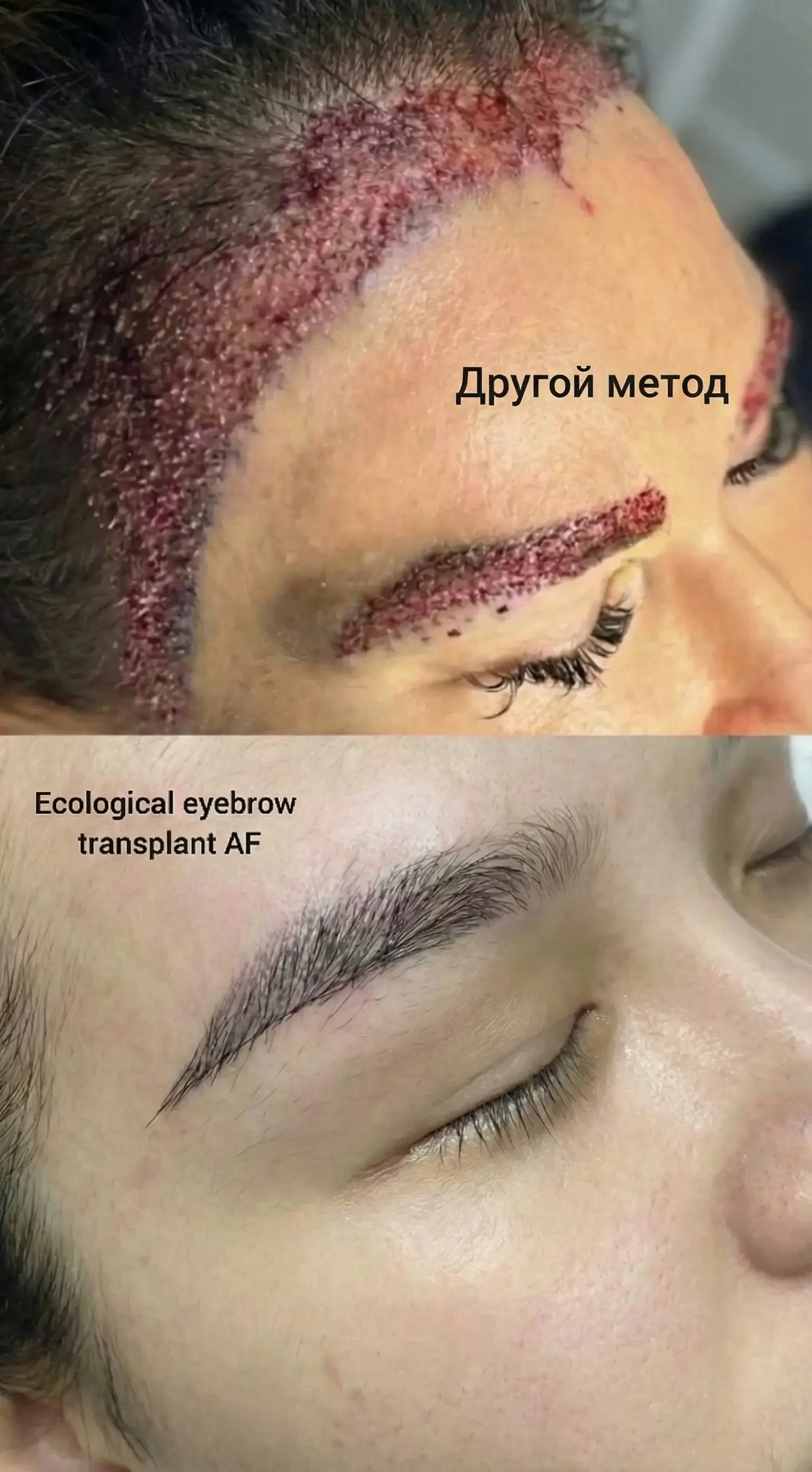Poor hair transplant density from traditional FUE method