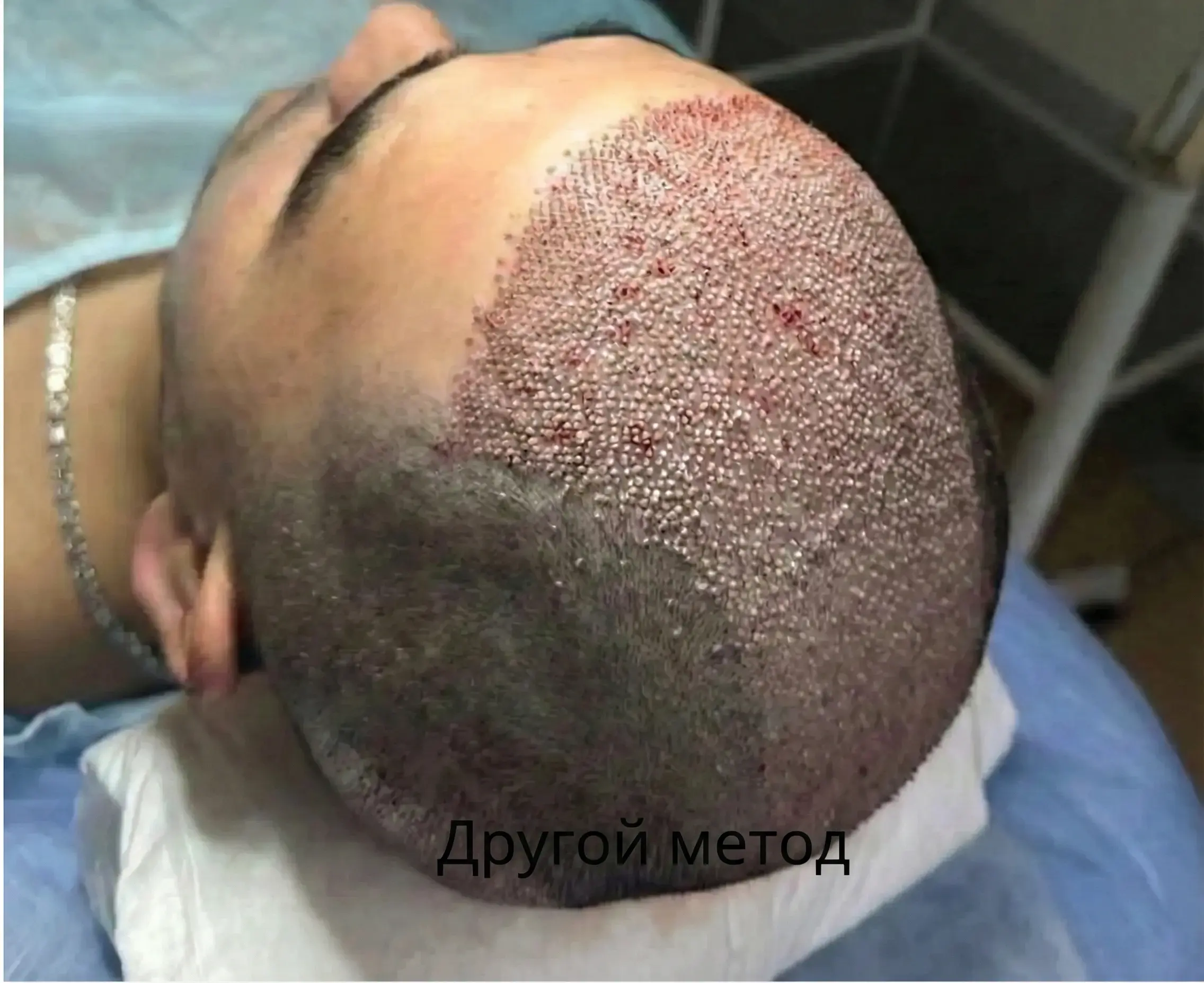 Unnatural hair growth direction from traditional transplantation